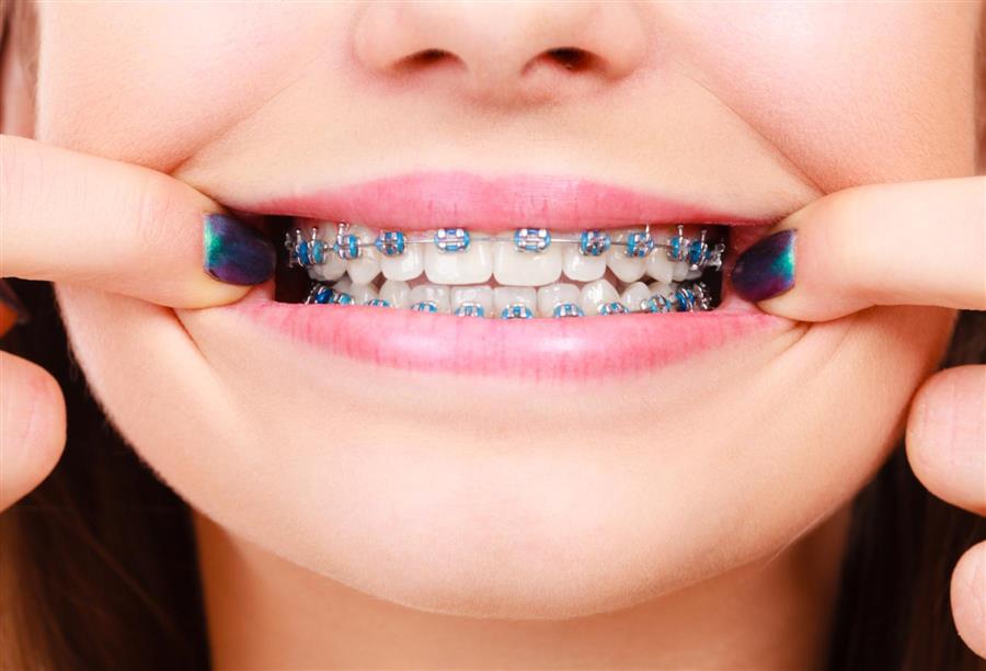 ما يجب أن تعرفه عن عمليات  تقويم الأسنان؟