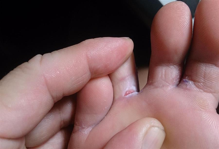 الدليل الكامل للتشخيص والوقاية من الفطريات بين أصابع القدمين