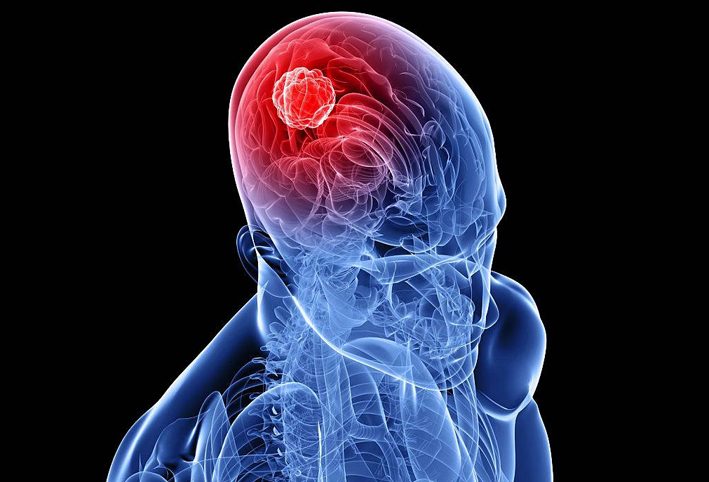 أورام المخ قد تكون سببا فى الإصابة بالوسواس القهرى والهلوسة
