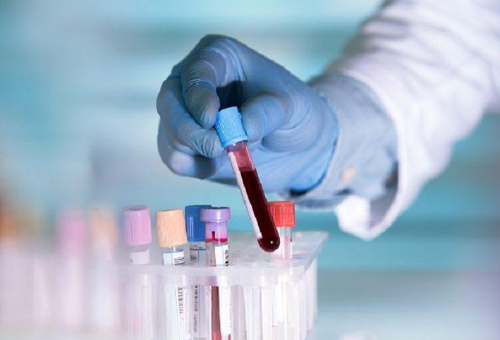 تطوير اختبار دم يمكنه تتبع مرض الزهايمر