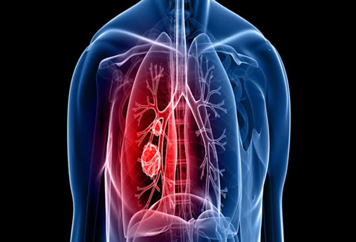 أعراض إذا ظهرت عليك فأنت تعاني من سرطان الرئة