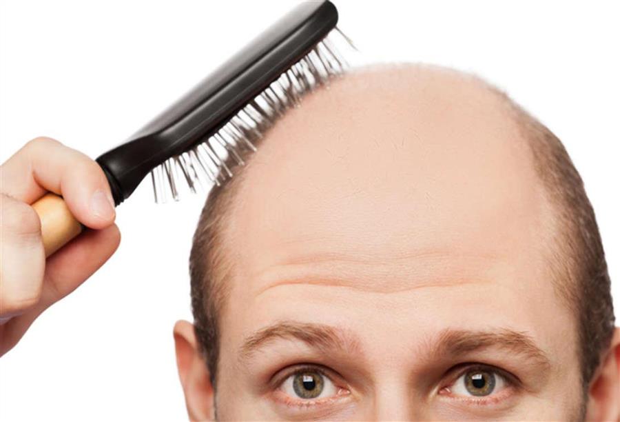 أدوية لنمو الشعر من جديد تحيي أمال الصلع