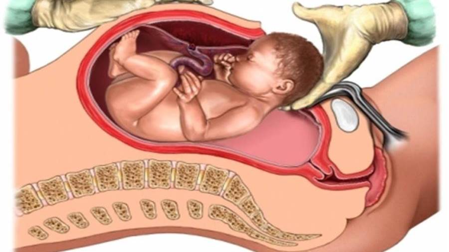 الولادة القيصرية .. بين الضرورة والاختيار