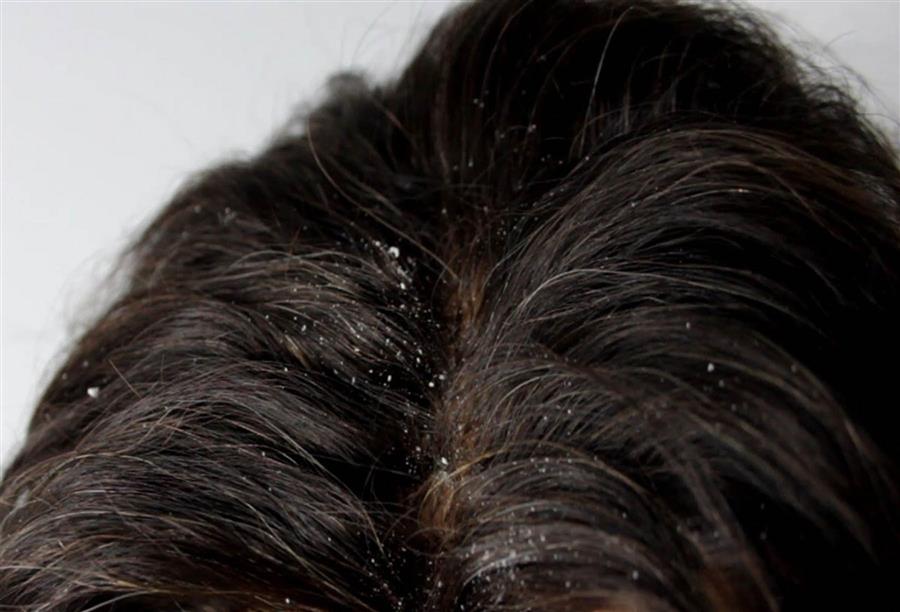 قشرة الشعر .. بين الأسباب الطبيعية والمرضية