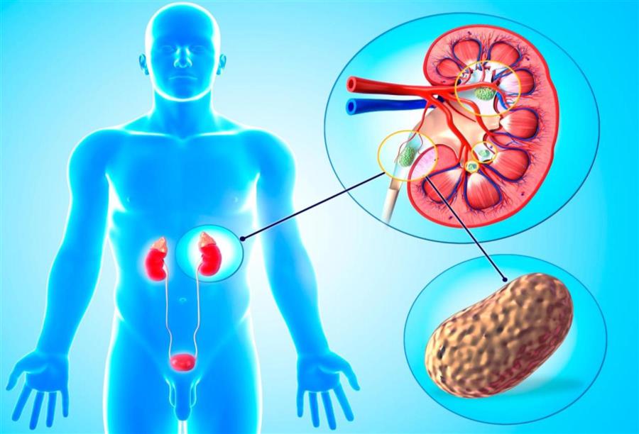 صدمة الموجات لتفتيت حصاة الكلى