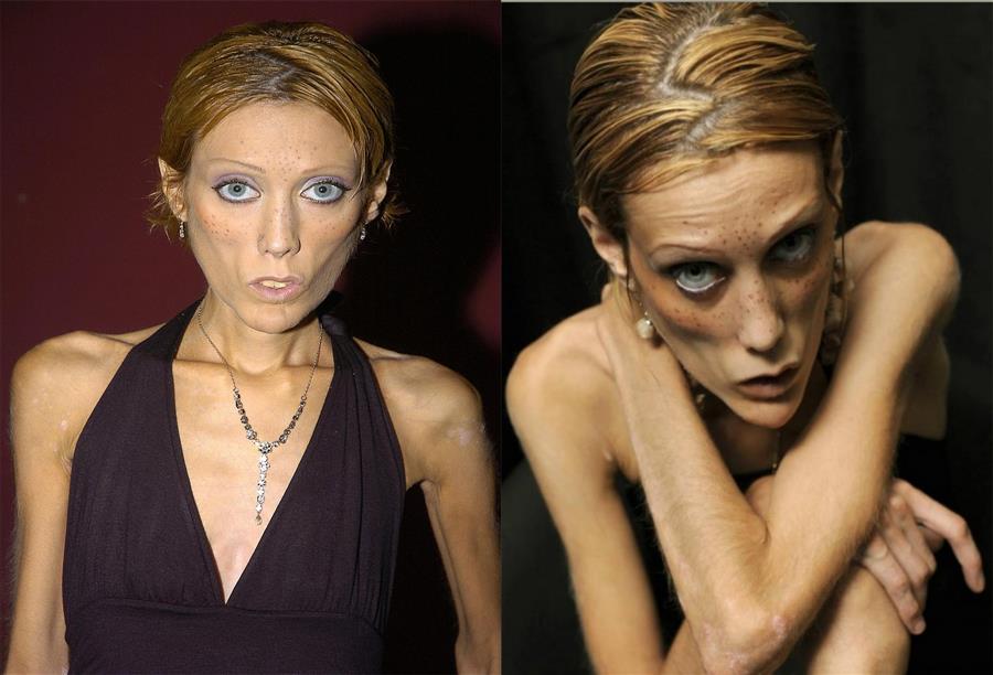 اسباب  البوليميا (الشره المرضي) والانوريكسيا (فقدان الشهية المرضي)  نفسية وعصبية وغالبا ما تصاب به الاناث أكثر من الرجال لان هاجس البدانة غالبا ما يعايش المرأة وليس الرجل