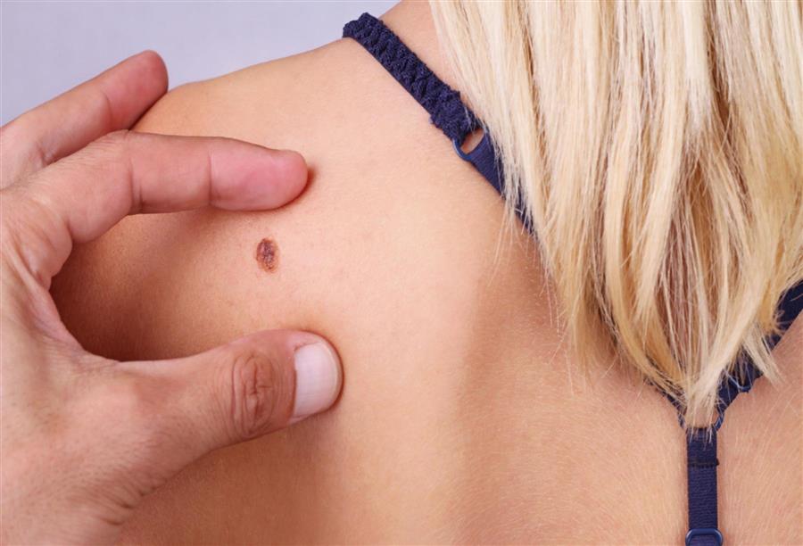 ما هو سرطان الجلد القتامي ( الميلانوما) ؟