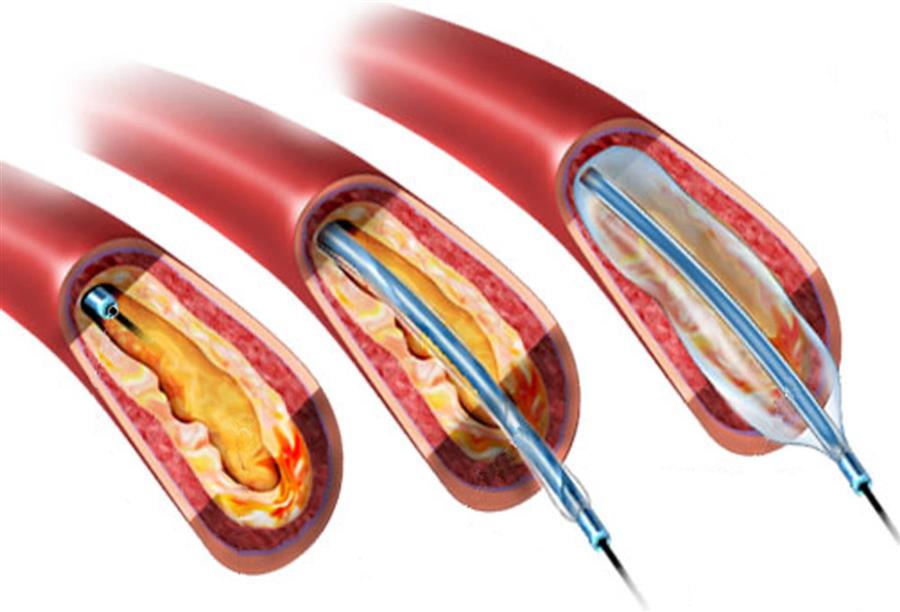 الدليل الكامل لعمليات توسيع شرايين القلب بالبالون