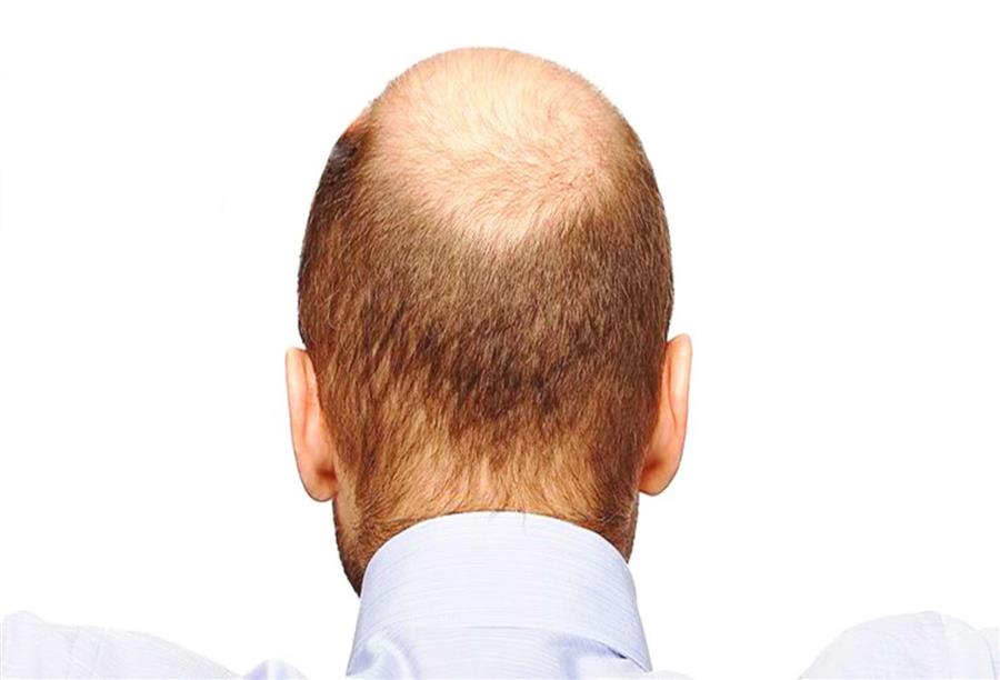 أحدث اكتشاف علمى طبيعى لعلاج الصلع .. استنساخ الشعر جينياً 