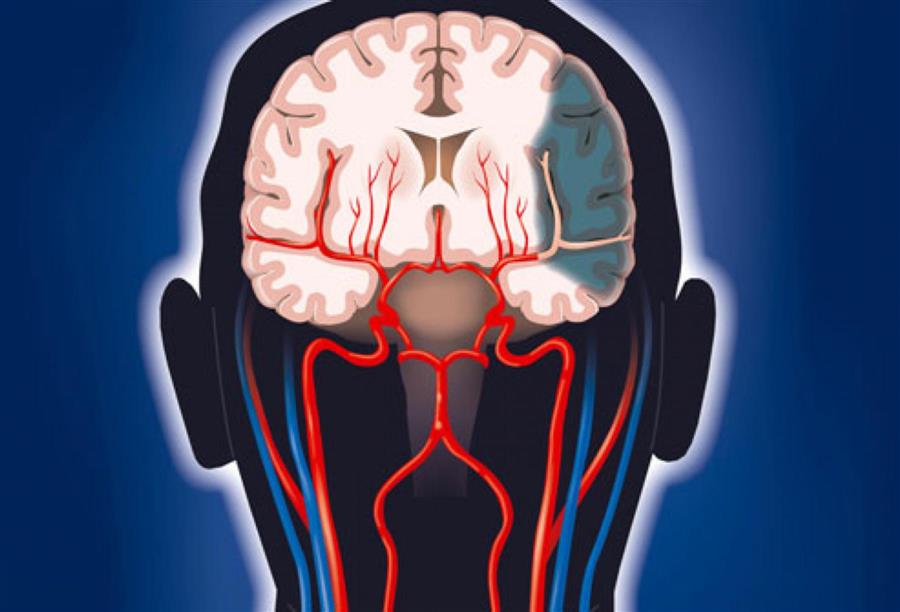 نصائح طبية لتجنب حدوث السكتات الدماغية