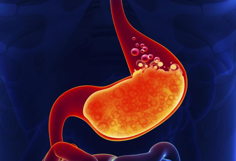 طريقة جديدة لعلاج الارتجاع الحمضي .. بواسطة المناظير