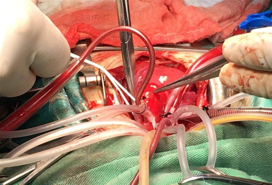 هل جراحات القلب التقليدية أقوى من العمليات الجديدة المبتكرة؟