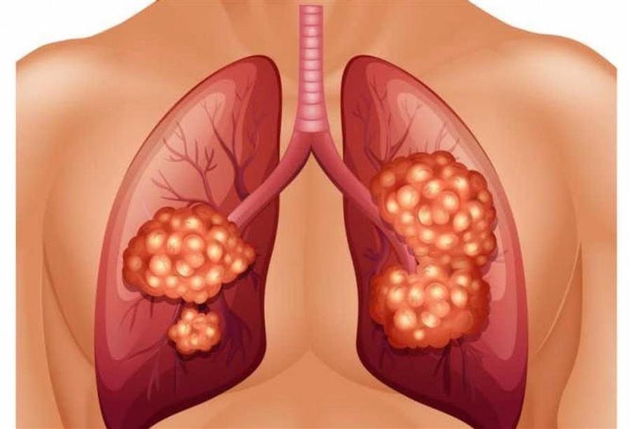 اكتشاف وسيلة جديدة للكشف عن سرطان الرئة في وقت مبكر