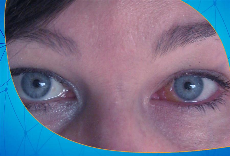 ما السبب في حدوث أكياس وانتفاخ حول العينين، ودوائر سوداء تحتهما؟