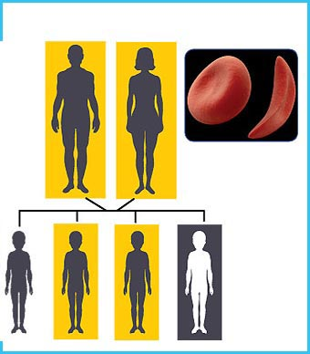 فقر الدم المنجلي .. هل يمكن تحويله إلى مرض يمكن التعامل معه؟