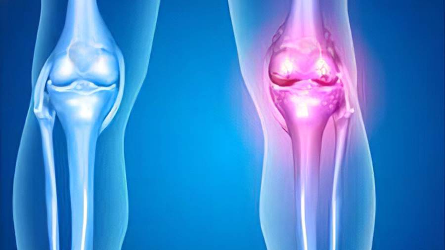 المريض شاب عمره 25 سنة يعاني من الهيموفيليا والجراحة استغرقت أكثر من 5 ساعات