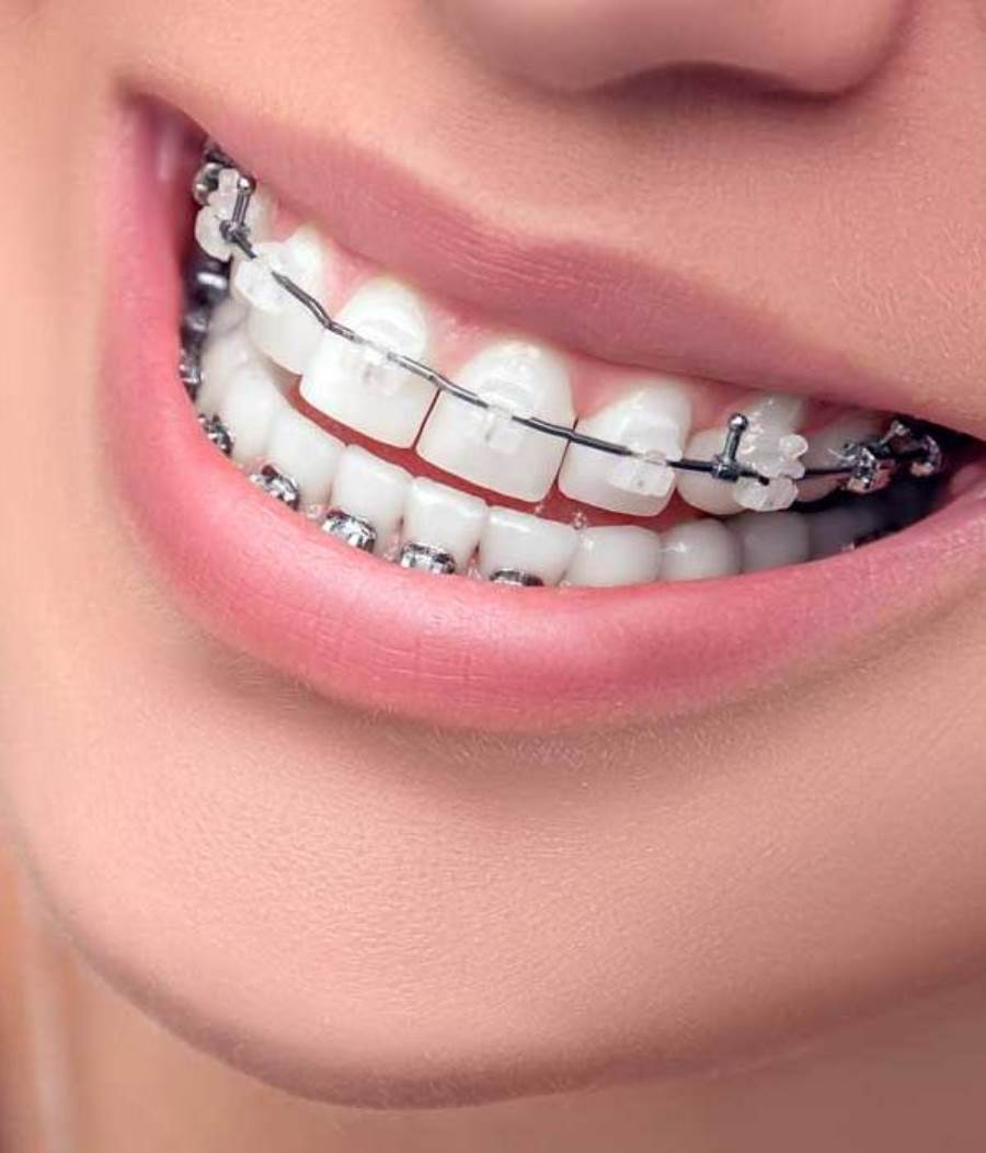 تشويه الأسنان .. بدعة نسائية في عمليات تجميل لجذب الرجال