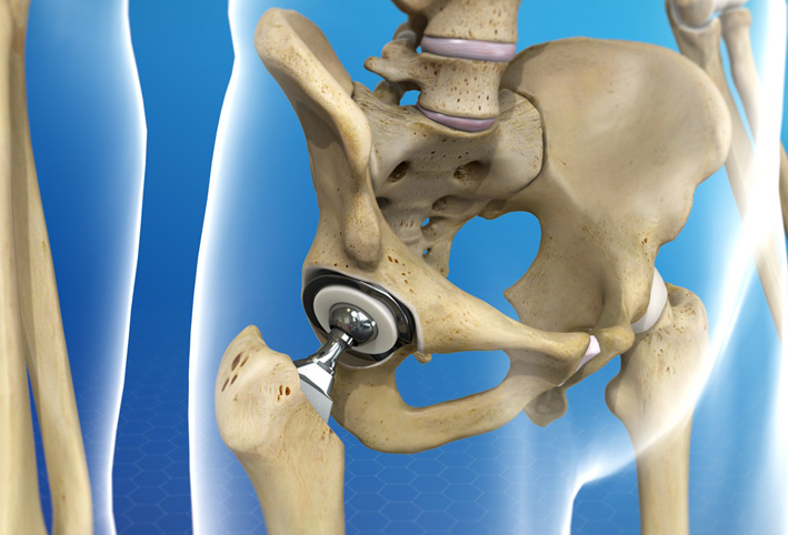 جراح بارز يقول أن استبدال مفصل الورك أسهل من مفصل الركبة