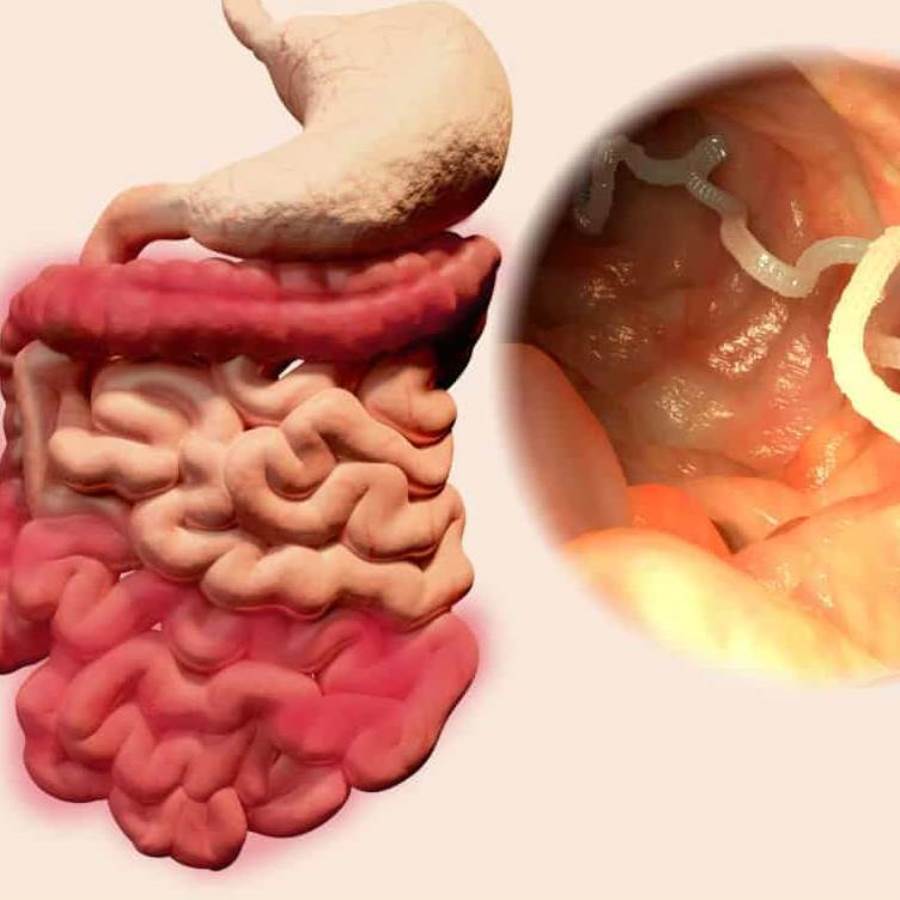 الدليل الكامل لمواجهة ديدان الأمعاء