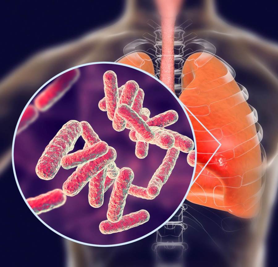 عقار جديد يقضى على 99 في المئة من بكتيريا السل في أسبوعين