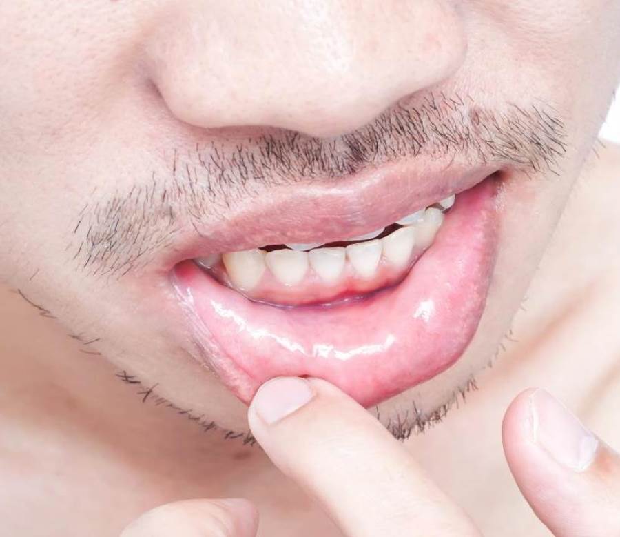   كيف نتجنب مشاكل قرحة الفم؟