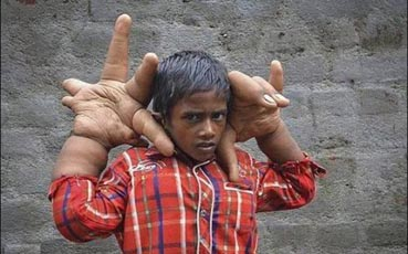  بالصور .. طفل هندي يعيش بـ"يدين عملاقتين"