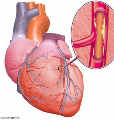 5 أعراض تكشف إصابتك بـ"تليف الكبد"