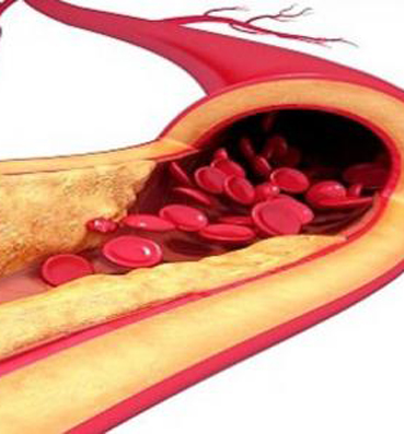 اختلال دهون الدم مرض صامت يسبب أمراض القلب والشرايين