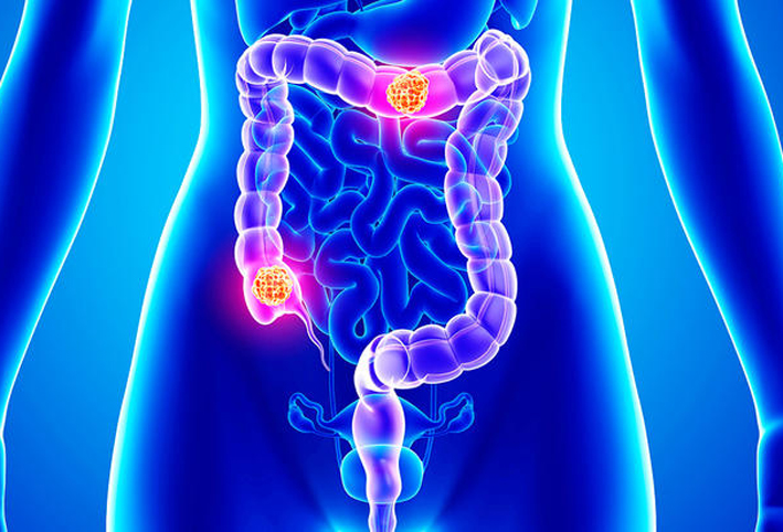 أعراض سرطان القولون التي يجب أن تعلمها المرأة
