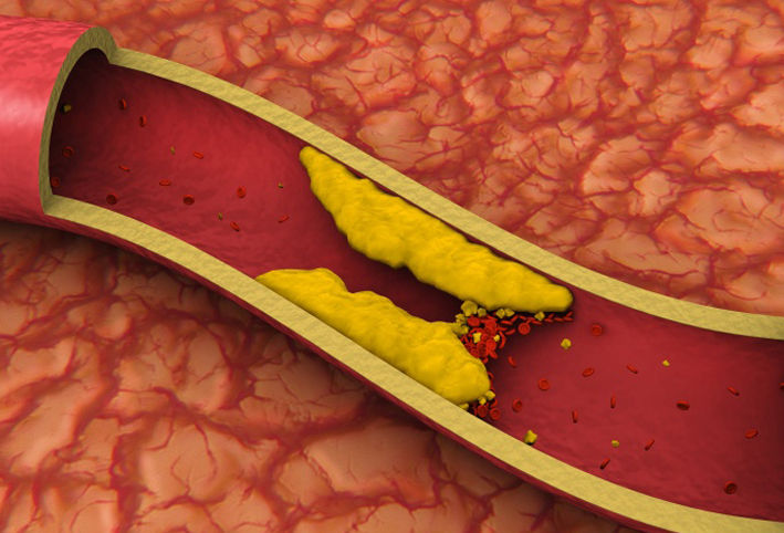 بروفيسور مصرى يقترح التخلى عن عقار الـ Statin لتخفيض معدلات الكولسترول بالدم