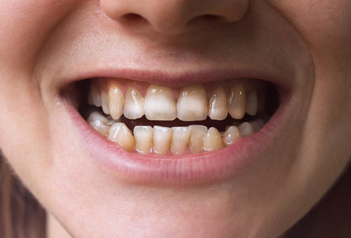 ما علاقة هذه العلامات على أسنانك بمناعتك الذاتية؟