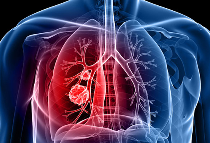  الآلاف من غير المدخنين يموتون سنويا بسبب سرطان الرئة فى إنجلترا 