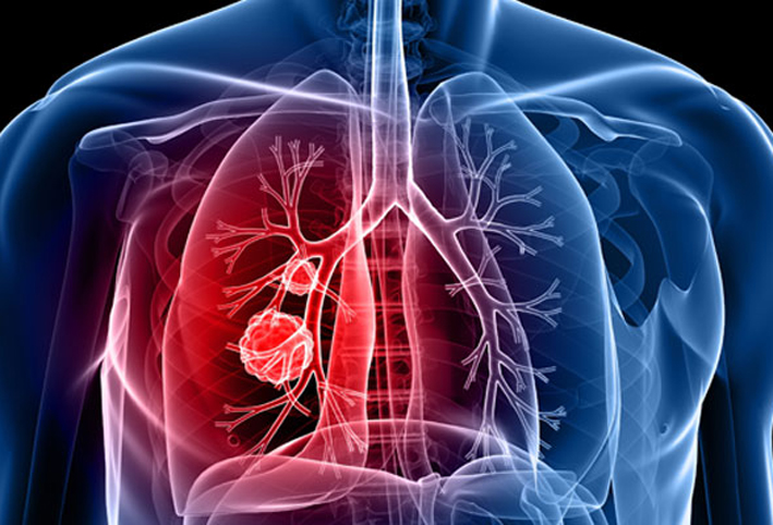 عوامل قد تزيد من خطر إصابتك بسرطان الرئة