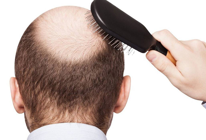 للرجال : إليكم بعض علاجات تساقط الشعر  