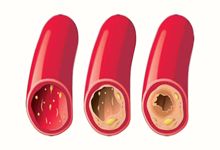 كيف يحدث انسداد الشرايين؟