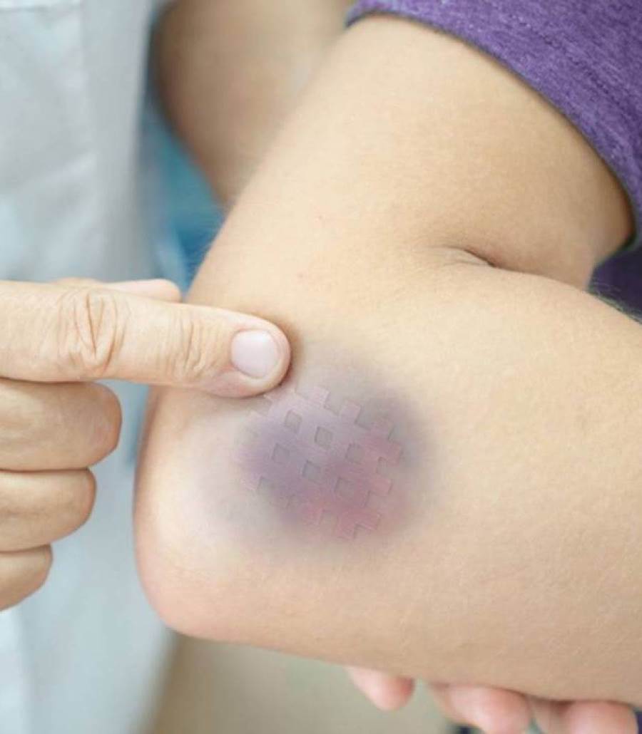 عمري 36 سنة، وأشكو من سهولة ظهور الكدمات على جلدي نتيجة لأبسط إصابة أو ارتطام بأي شيء صلب، وفي كثير من الأحيان تظهر الكدمات دون أن أتذكر إصابتي بأي شيء صلب، وكثيرا ما أشعر بالحرج نتيجة لتغيرات لون الج