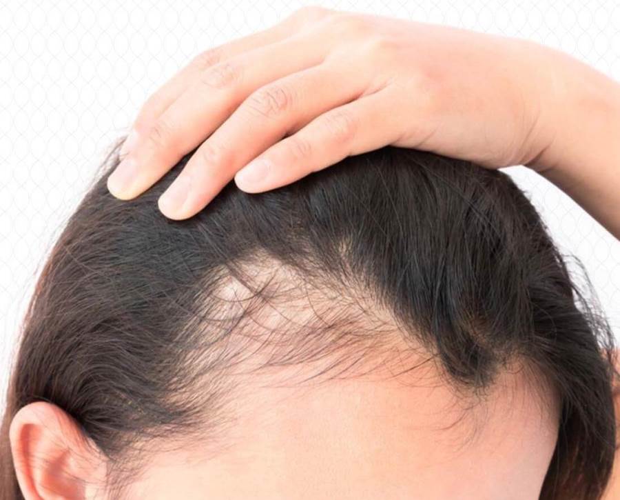 هل علاج تساقط الشعر فى حالة الوراثة ( صلع وراثى ) ايجابى وفعال ؟؟ وما نوع العلاج  ؟؟