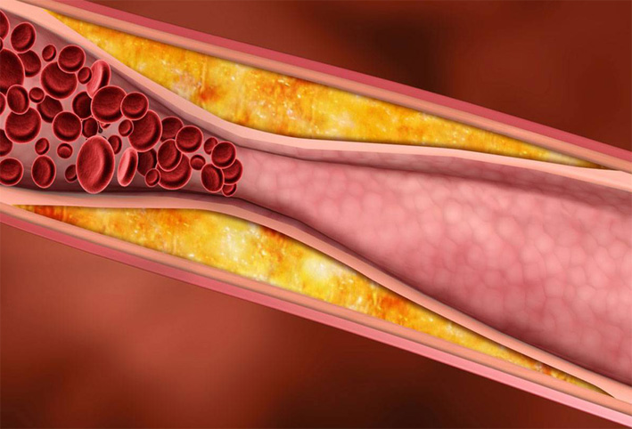 عوامل تنذر بإصابتك بتصلب الشرايين