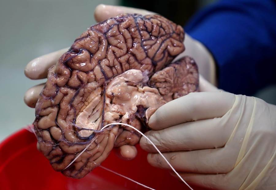 خبر سار .. علماء يتوصلون لأمل جديد فى الاكتشاف المبكر لأورام الدماغ