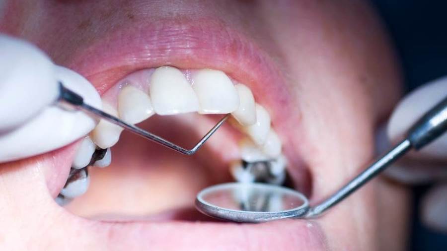 FDA تحذرمن حشو الأسنان