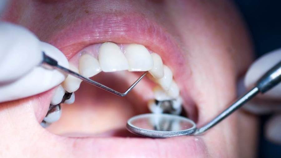 FDA تحذرمن حشو الأسنان .. إليكِ التفاصيل