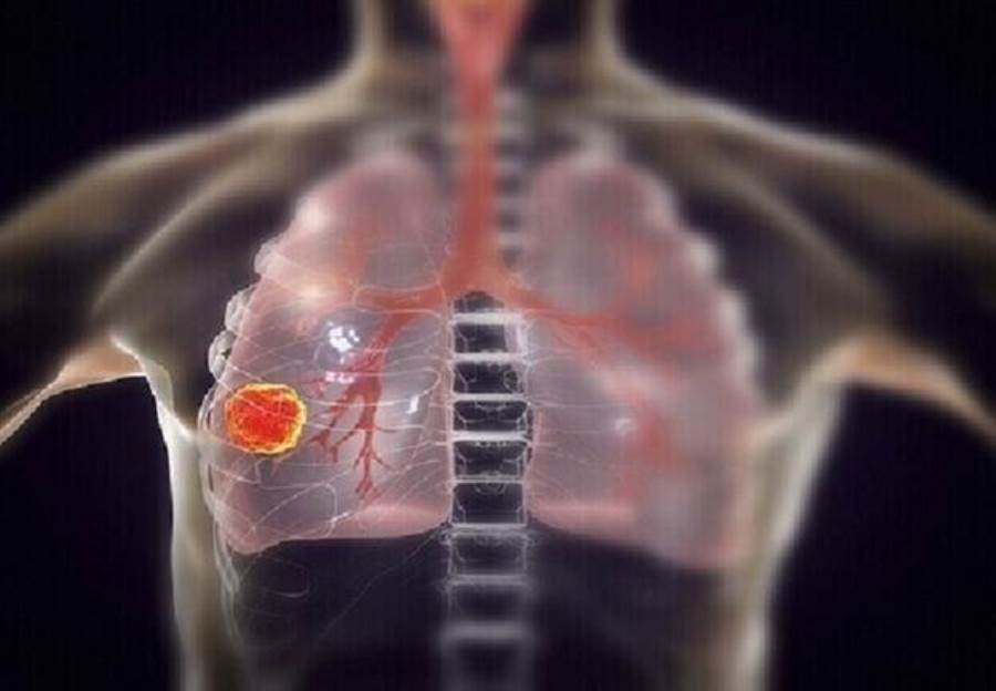 تورم في جزء معين من الجسم يدل على الإصابة بسرطان الرئة!