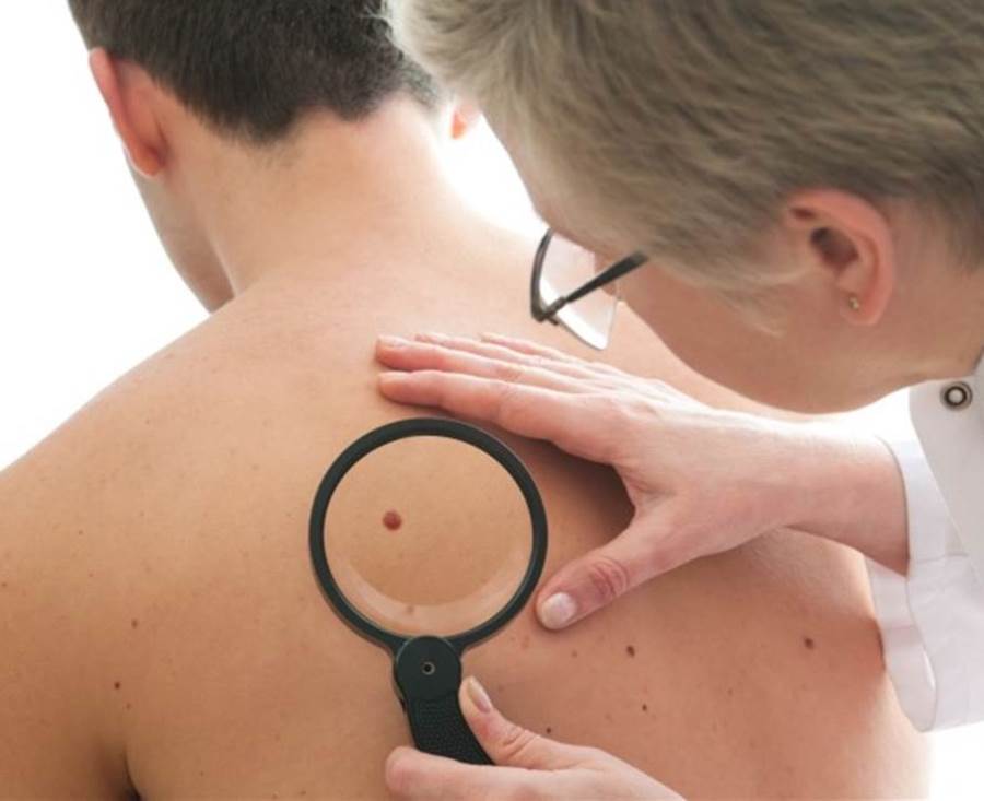 سرطان الجلد .. دراسة تحذر من 3 أنواع "شامات"