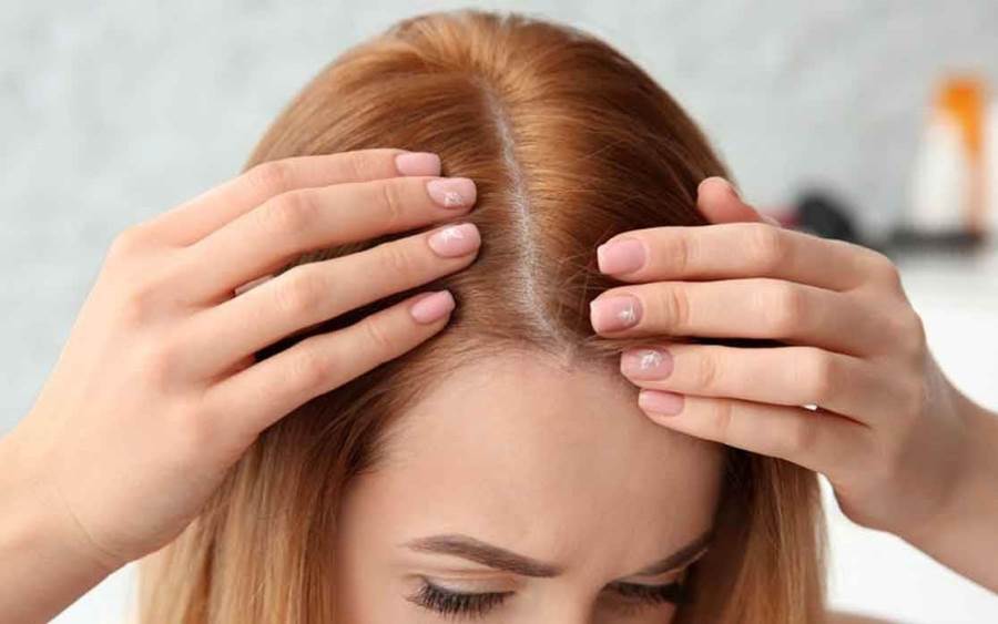 متى تلجأ النساء لعملية زراعة الشعر؟