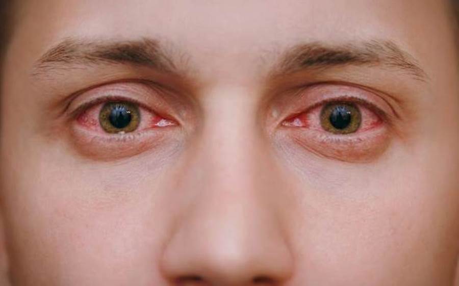 أسباب الإصابة بالتهاب الملتحمة وطرق علاج العين الوردية