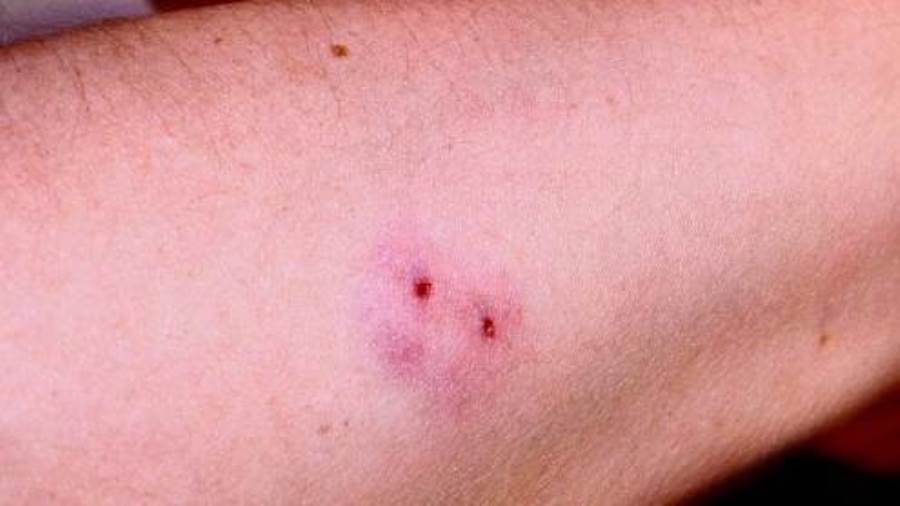 لدغة الثعبان