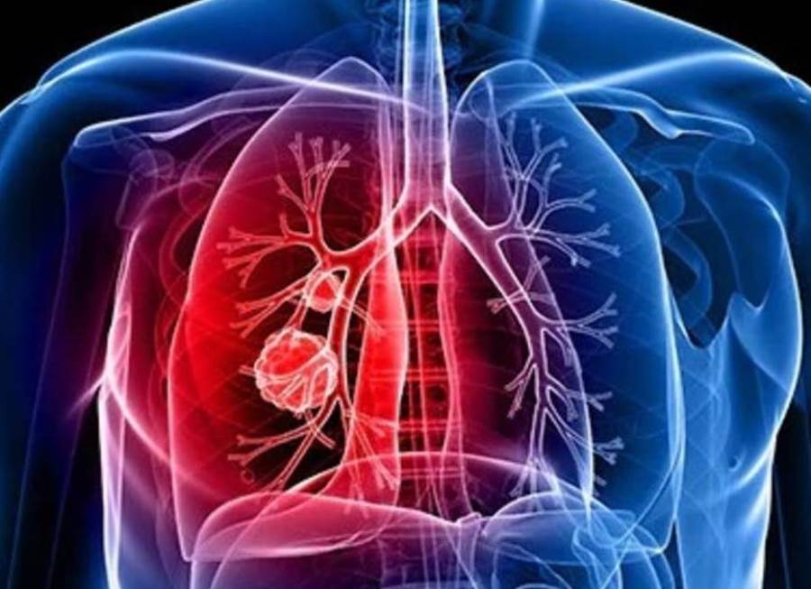 كيف يسبب التدخين سرطان الرئة؟  أستاذ جراحة صدر يجيب