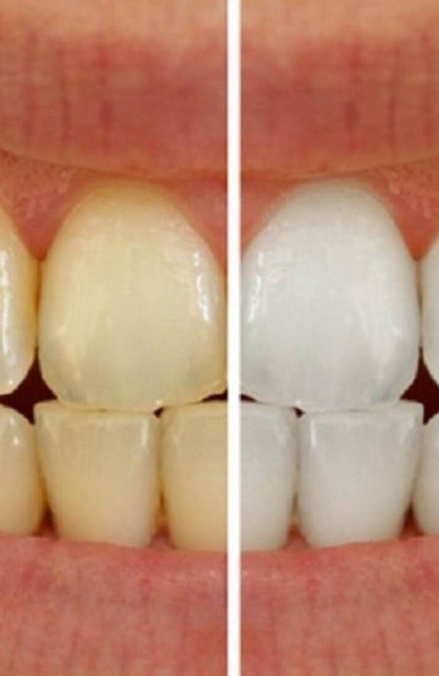 وصفة سحرية لإزالة جير الأسنان