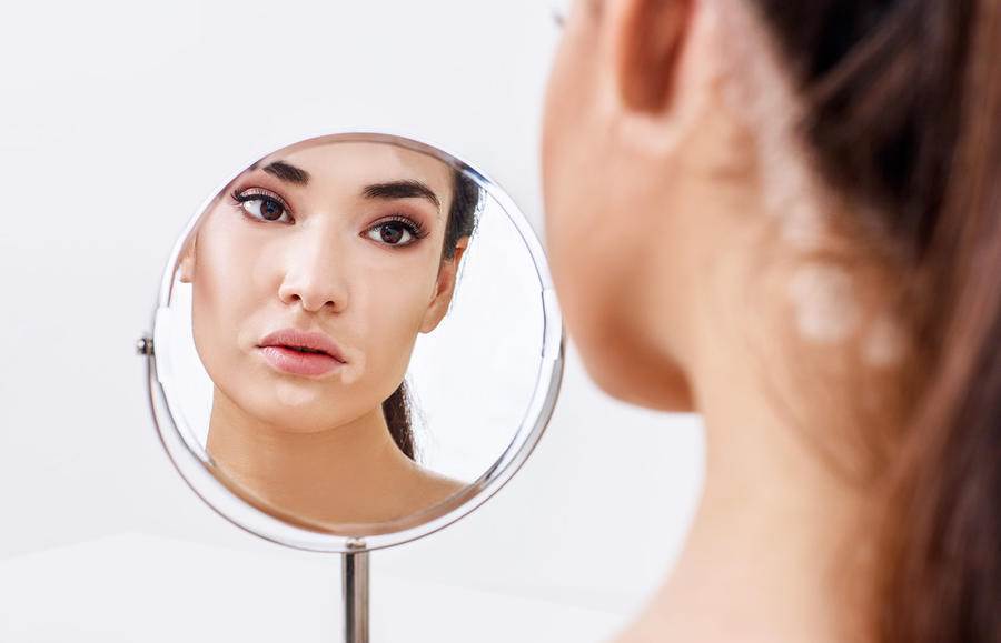 علاج جديد للبهاق أثبت فاعلية عالية جداً خصوصاً على الوجه