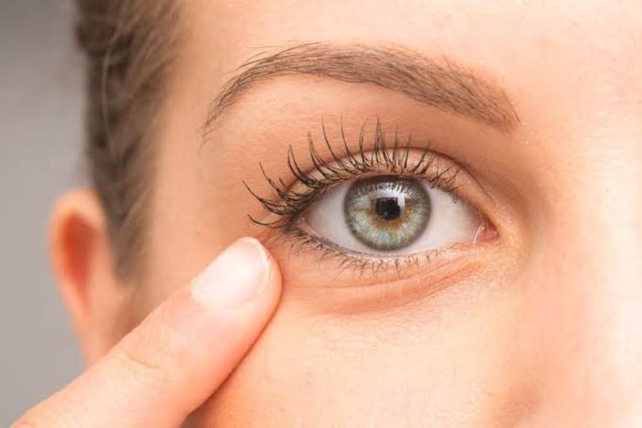 أسباب جفاف الجلد حول العين.. وطرق العلاج